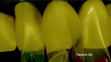 The Bioclear Method: Injection molding