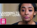 Burn Scars & Relationships: Accepting Love
