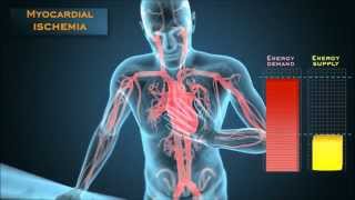 Understanding the energetic mechanisms that cause angina pectoris