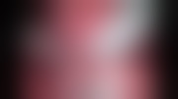 Robotic Partial Nephrectomy in a Solitary Kidney for a Endophytic tumor