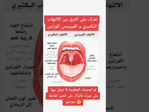 الفرق بين الإلتهاب البكتيري والفيروسي للوزتين