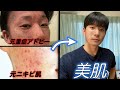【完全ガイド】元重症アトピー、ニキビ肌だった僕が美肌を手に入れた食事と習慣