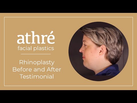 Rhinoplasty Before and After | Patient Testimonial at Athre Facial Plastics