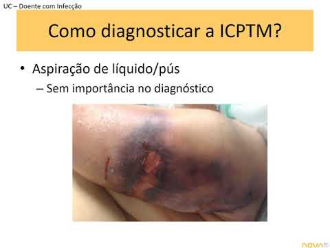 Vídeo: O Tempo é Essencial No Tratamento De Infecções Necrosantes Dos Tecidos Moles: Uma Revisão Sistemática E Uma Meta-análise