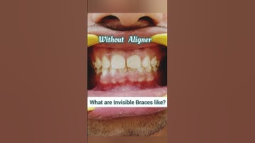 Invisible Braces be like this! Clear Aligners for Teeth spacing: Dr. Srishti Bhatia #smile #braces