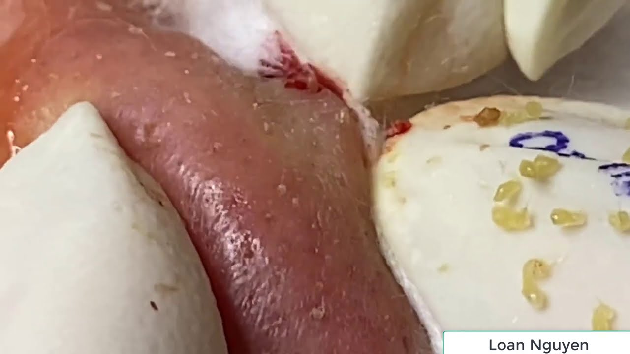 Blackheads extraction with Loan Nguyen Spa (n10)