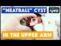 Giant Cyst Removal!!