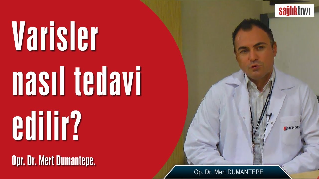 Varisler nasıl Tedavi edilir , kaç çeşit tedavi yöntemi vardır? Op. Dr. Mert Dumantepe