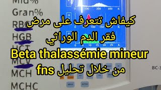 كيفاش تتعرف على مرض فقر الدم الوراثي beta thalassémie mineur من تحليل fns