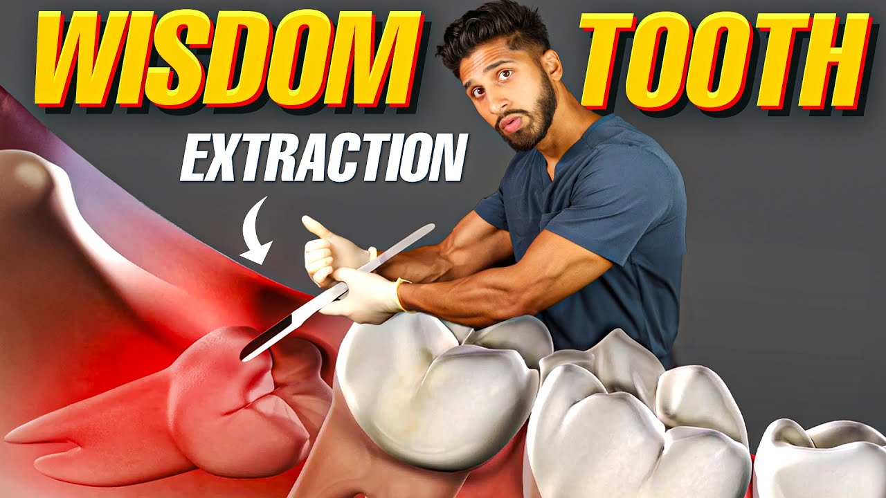 Wisdom Teeth Extraction (How to Flap, Section, and Extract Impacted ...