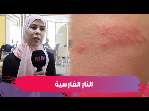 مرض الزونا الدكتورة كوثر عناني تكشف أسبابه وأعراضه وطرق علاجه