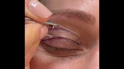 Upper Blepharoplasty Markings
