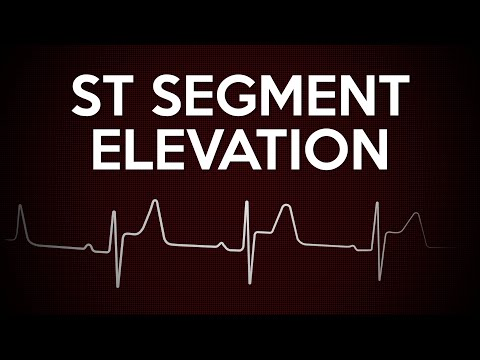 st segment elevation strip