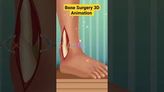 3D Animation Bone Plate Surgery ✓✓ | screenshot 2