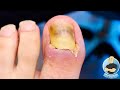 THE WORST LIFTED TOENAIL EVER?! ***YOU WON'T BELIEVE WHAT'S UNDERNEATH!!!***