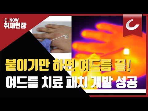 여드름 치료하는 투명 온열 패치 개발