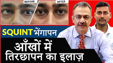 भेंगापन (तीरछापन) का इलाज | Near LIVE Squint Surgery Demonstration!