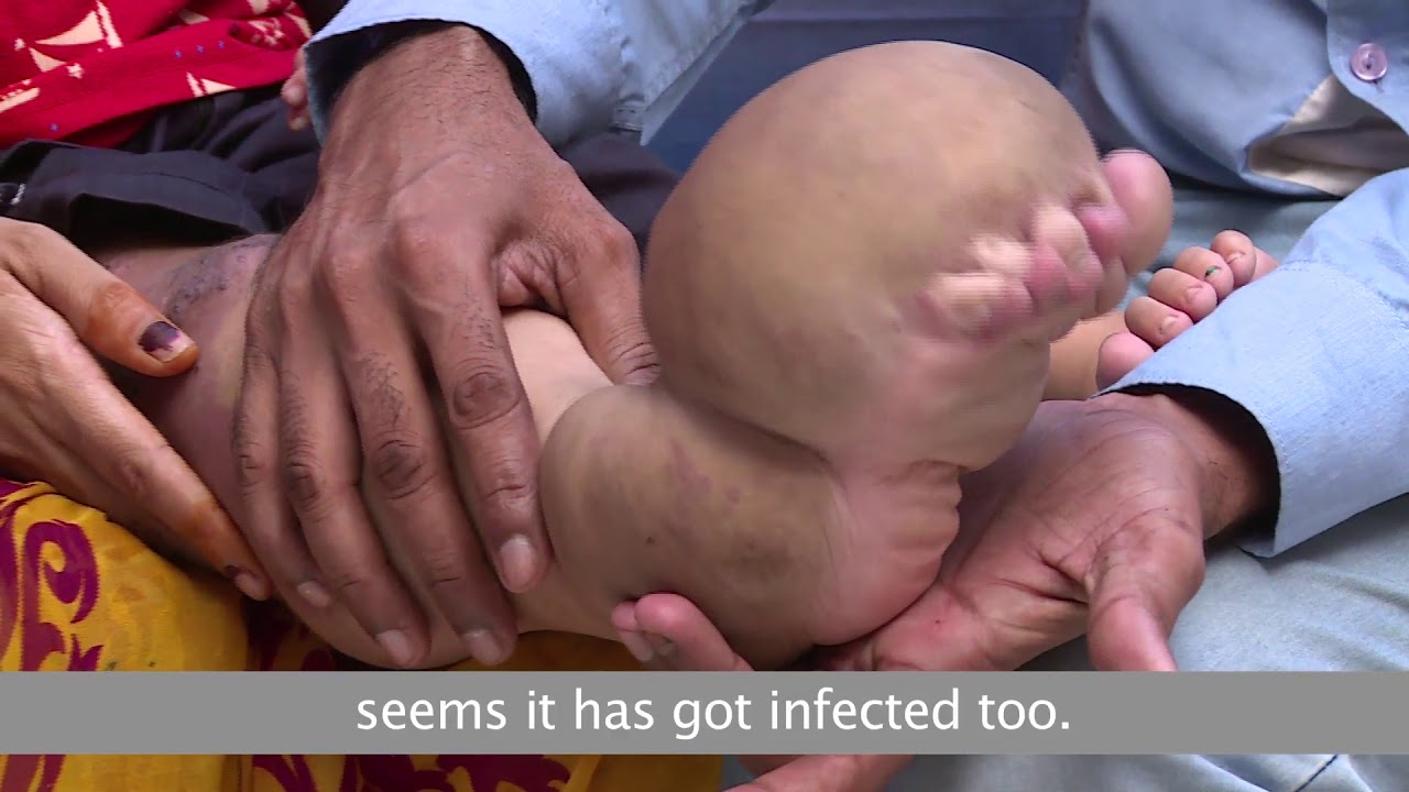 Please Support To Aaruhi For His Elephantiasis Disease Sewa