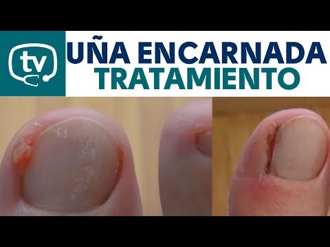 Video: Uña Encarnada: Que Hacer En Casa, Revisiones