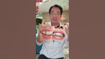 Lightforce v Regular Brace. What’s the difference? #orthodontist #braces #lightforce