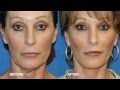 Facelift and Necklift Patient Testimonial | Carmel Valley Facial Plastic Surgery