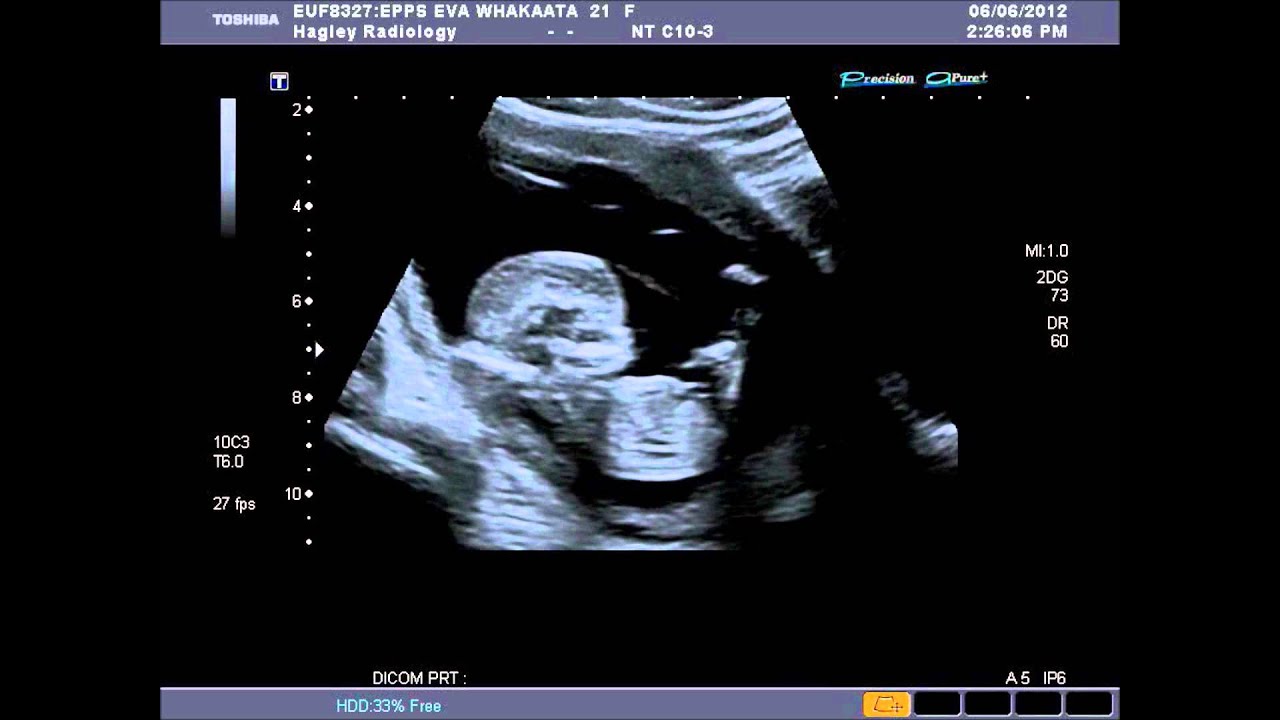 normal fetal heart rate at 6 weeks normal fetal heart rate at 6 weeks
