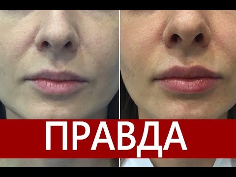 Увеличение губ! ⚠️ Пухлые губы ⚠️ПРАВДА⚠️: зачем это делать и как!