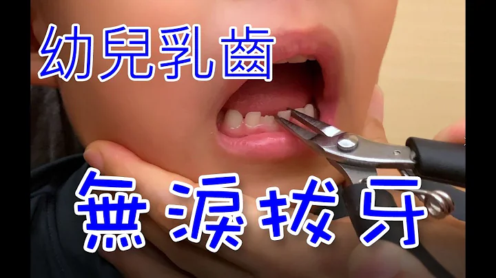 幼兒乳齒 無淚拔牙 - 天天要聞