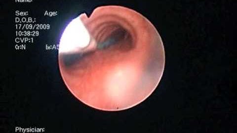 EZ Blocker insertion