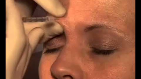 Intrafollicular Injection Technique in the Glabellar Musculature