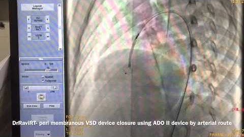 DrRaviRT - Perimembranous VSD device closure by arterial route using ADO II device steps