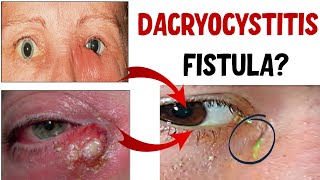 DACRYOCYSTITIS: Lacrimal Sac Infection| Stages, Complications and Treatment