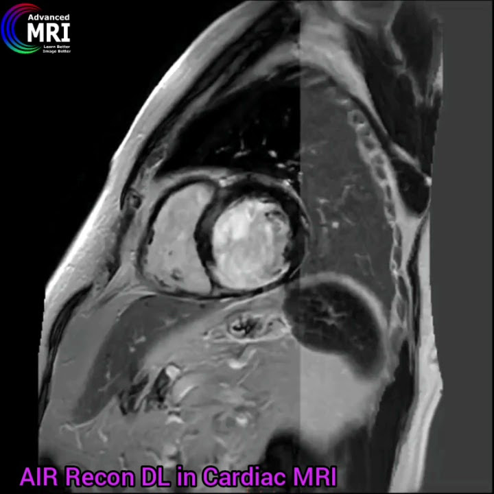 AIR Recon DL in Cardiac MRI