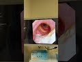reconstruction of the laryngeal cavity using a superior thyroid artery perforator flap。Huang Xinpeng