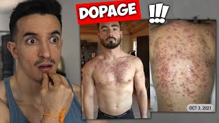 HORRIBLE ACNÉ À CAUSE DU DOPAGE !