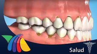 Estrés afecta los dientes | Salud Resimi