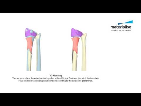 Distal Radius Malunion | Patient-Specific Guides for Radial and Ulnar Osteotomy