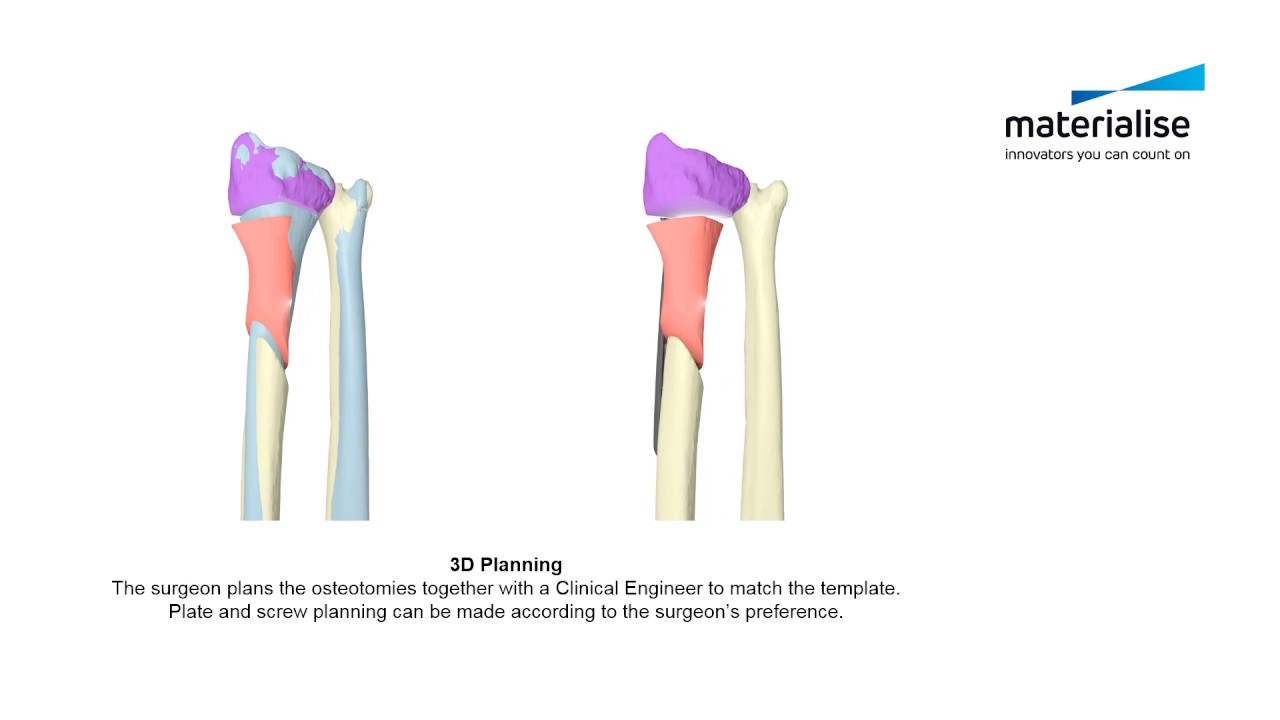 distal radius malunion patient specific guides for radial and