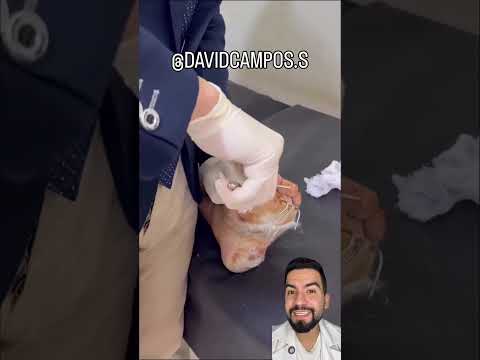 CLAVOS EN EL PIE