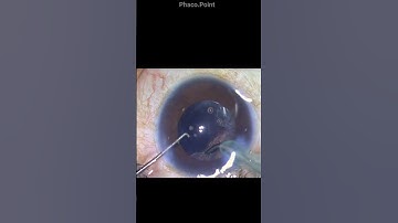 The "Windshield Wiper motion ( side to side) for safe and effective cortical aspiration during IA