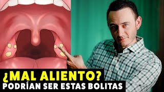 Bolitas blancas en la garganta = MAL ALIENTO | Causa y Solución Tonsilolitos | Cáseum en Anginas