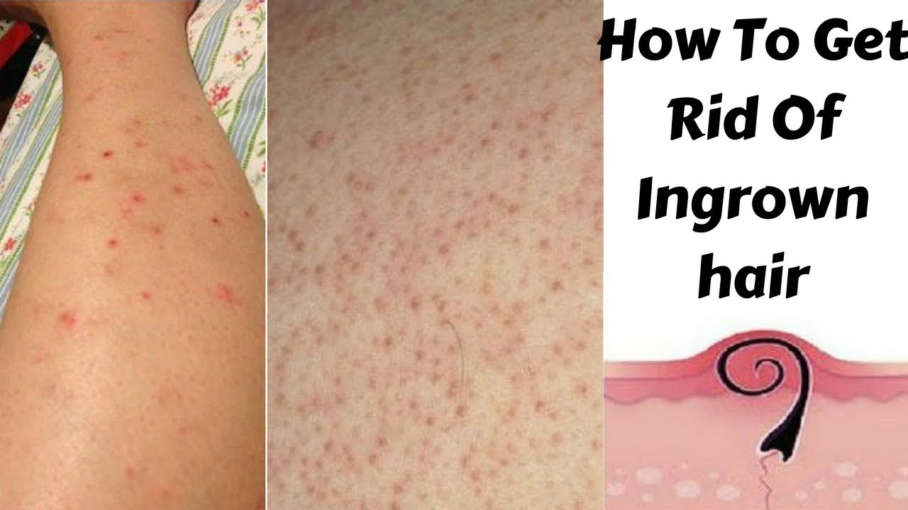 Top 5 Home Remedies To Get Rid Of Ingrown Hair And Red