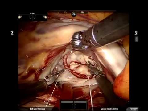 Robotic repair of mitral valve and PFO closure, Charles Anderson, MD