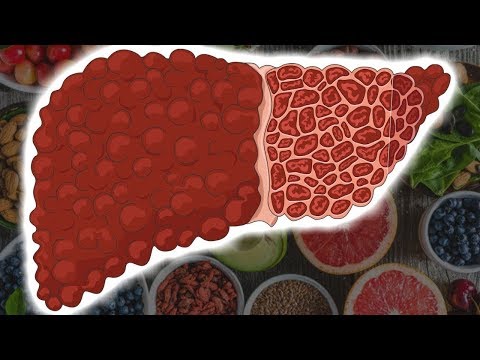 Wideo: Dieta Na Hemochromatozę: Pokarmy Do Spożycia I Pokarmy, Których Należy Unikać