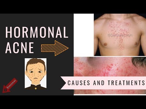 HORMONAL ACNE |   Causes and Treatments ( in Hindi) | MENTARGET.