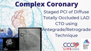 Staged PCI of Diffuse Totally Occluded LAD CTO using Antegrade/Retrograde Technique