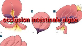 OCCLUSION INTESTINALE AIGUE