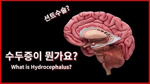 수두증이 뭔가요? (Hydrocephalus)