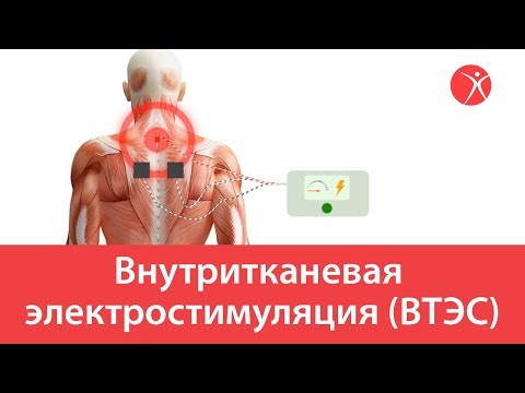 Внутритканевая электростимуляция (ВТЭС)