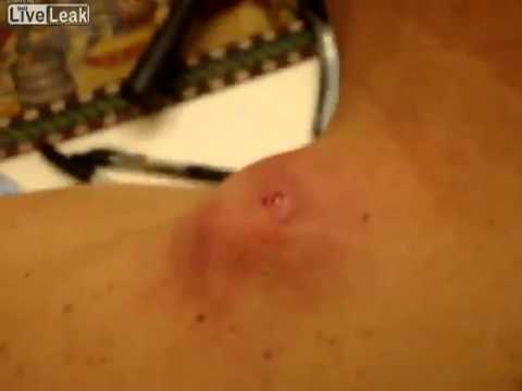 Vidéo Gore gros bouton de pu dans le dos - YouTube